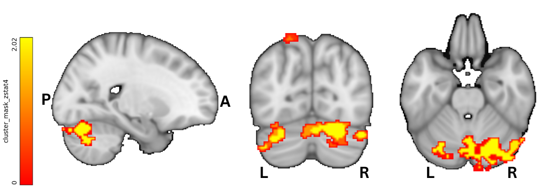 Right cerebellar Crus I region