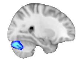 Right cerebellar Crus I region